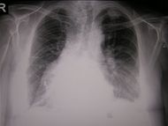 Léčba hypertyreózy radiojodem vede k vyššímu výskytu kardiovaskulárních úmrtí a neoplazií